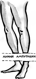 Линия ампутации